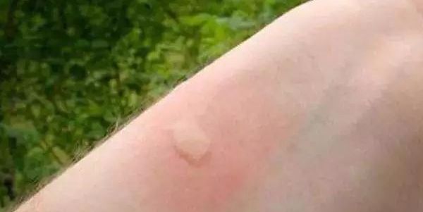 蚊子消灭的物理方法_消灭蚊子_蚊子消灭最好用什么药